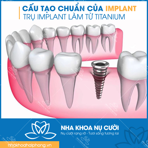 cau-tao-chuan-rang-Implant