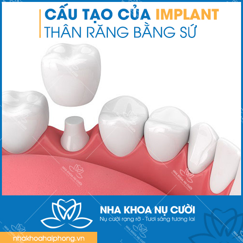 kham-pha-cong-nghe-trong-rang-Implant-hien-dai