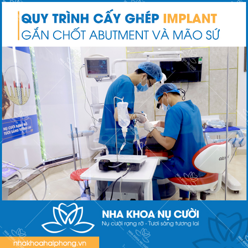 Quy-trinh-cay-ghep-implant-chuan-nha-khoa