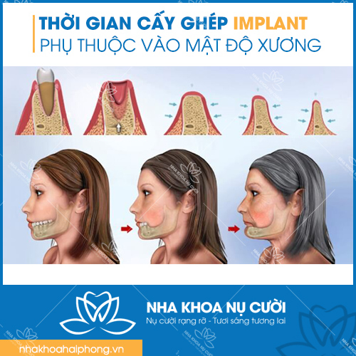 thoi-gian-cay-ghep-Implant-mat-bao-lau