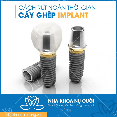thoi-gian-cay-ghep-Implant-mat-bao-lau