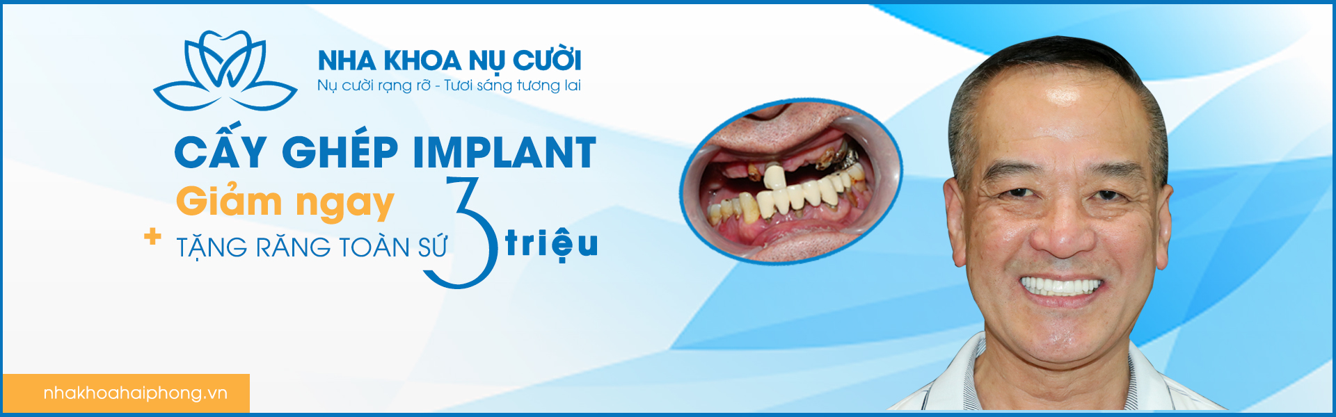 KHÁM PHÁ CÔNG NGHỆ TRỒNG RĂNG IMPLANT HIỆN ĐẠI
