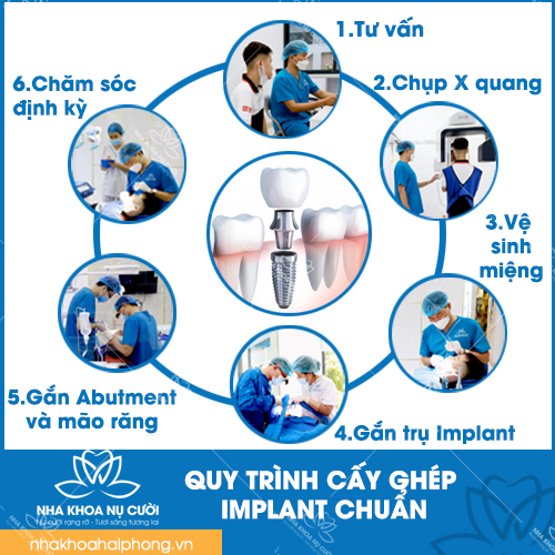 TÌM HIỂU VỀ QUY TRÌNH CẤY GHÉP IMPLANT CHUẨN NHA KHOA