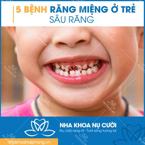 5-benh-rang-mieng-thuong-gap-o-tre