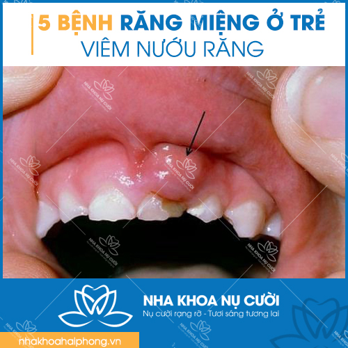 5-benh-rang-mieng-thuong-gap-o-tre