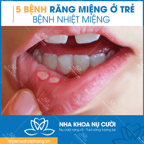 5-benh-rang-mieng-thuong-gap-o-tre