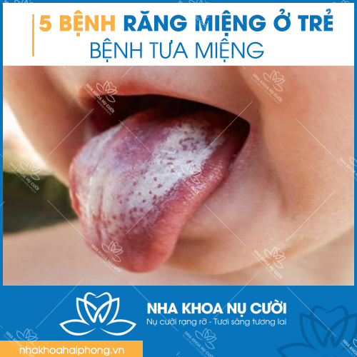 5-benh-rang-mieng-thuong-gap-o-tre