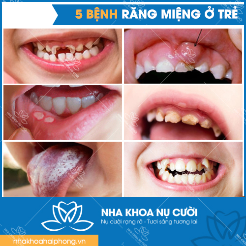 5 BỆNH LÝ RĂNG MIỆNG TRẺ EM THƯỜNG GẶP