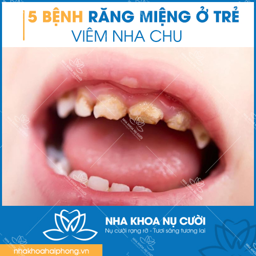 5-benh-rang-mieng-thuong-gap-o-tre