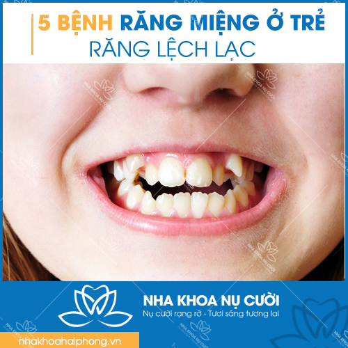 5-benh-rang-mieng-thuong-gap-o-tre