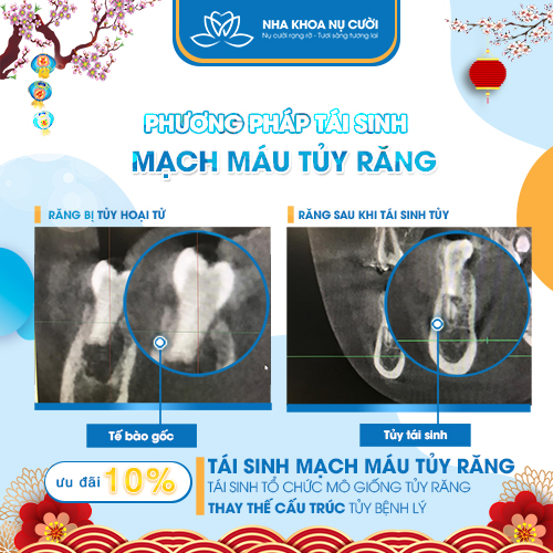 PHƯƠNG PHÁP TÁI SINH MẠCH MÁU TỦY RĂNG