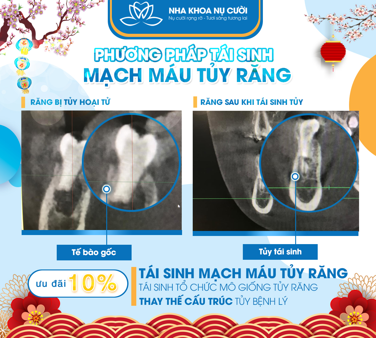 phuong-phap-tai-sinh-mach-mau-tuy-rang