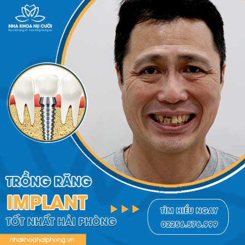 CẤY GHÉP IMPLANT Ở ĐÂU TỐT TẠI HẢI PHÒNG