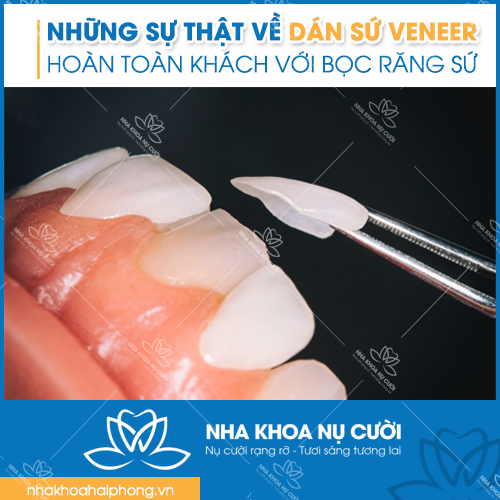 su-that-nen-biet-ve-dan-su-veneer
