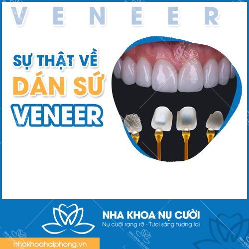 NHỮNG SỰ THẬT VỀ DÁN SỨ VENEER MÀ BẠN NÊN BIẾT