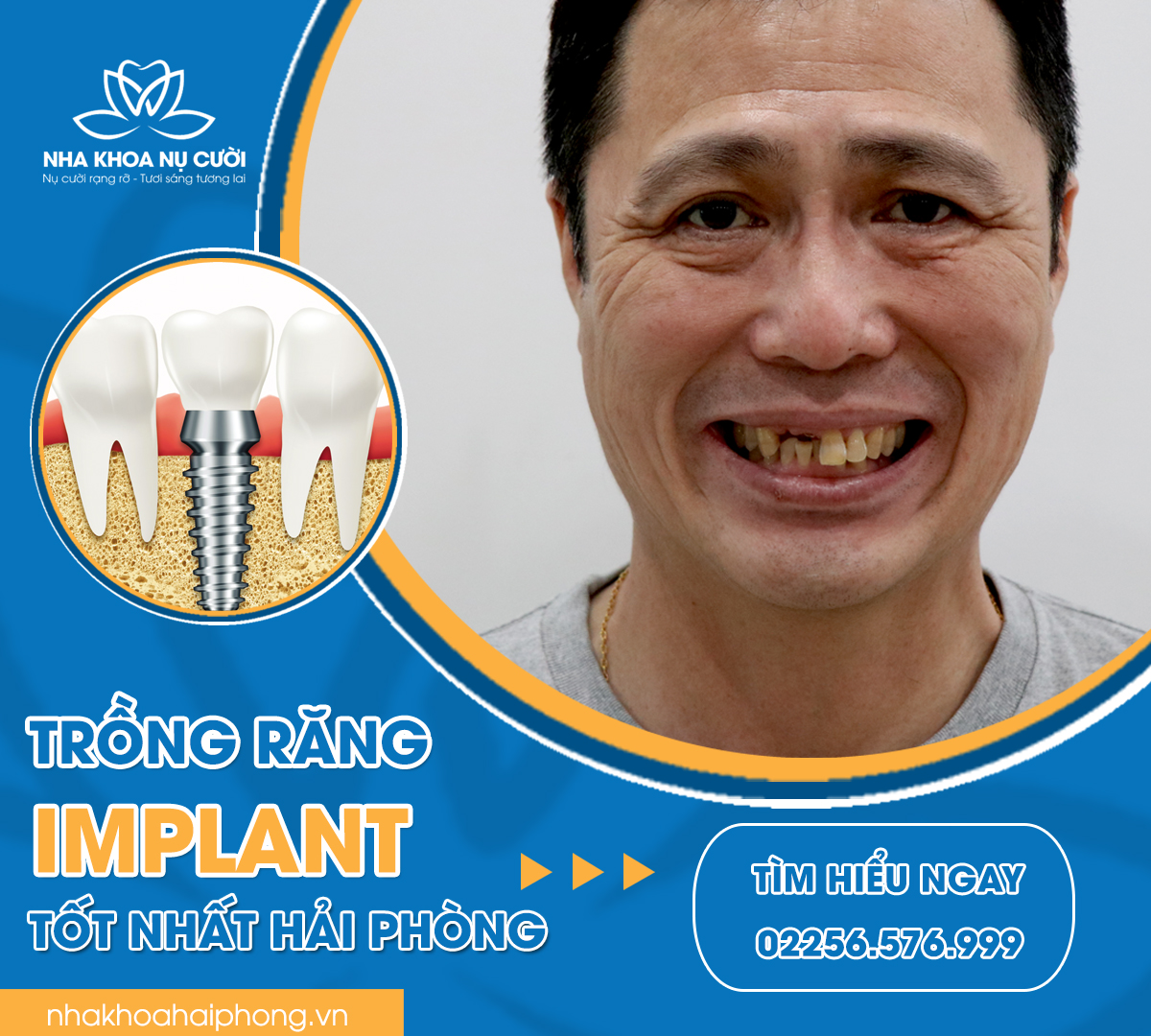 Cay-ghep-implant-o-dau-tot-nhat-hai-phong
