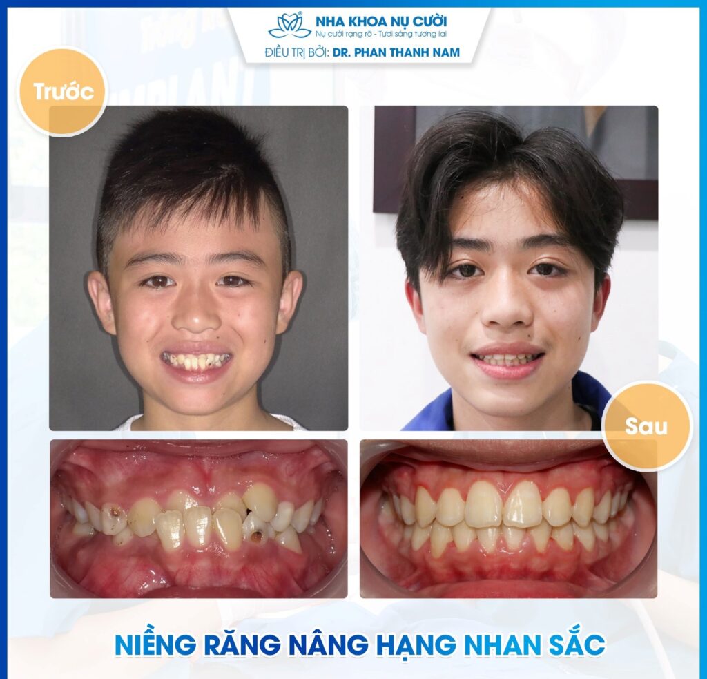 Hải Anh - Khách hàng niềng răng tại Trung tâm Nha Khoa Nụ Cười