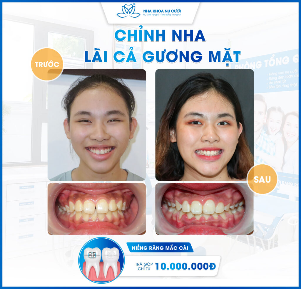 Chỉnh nha