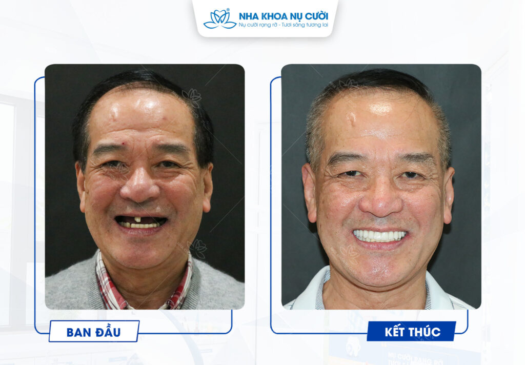 (Chú Nguyễn Đạt - Khách hàng cấy ghép Implant tại Trung tâm Nha Khoa Nụ Cười)