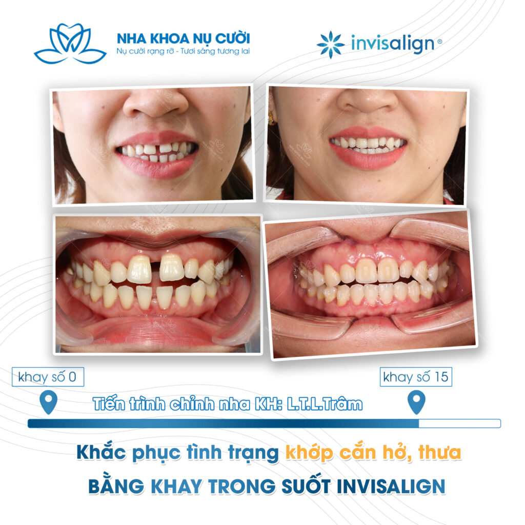 Khách hàng L.T.T.L.Trâm chỉnh nha Invisalign tại Trung tâm Nha Khoa Nụ Cười