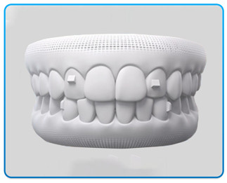  Attachment gắn trên răng