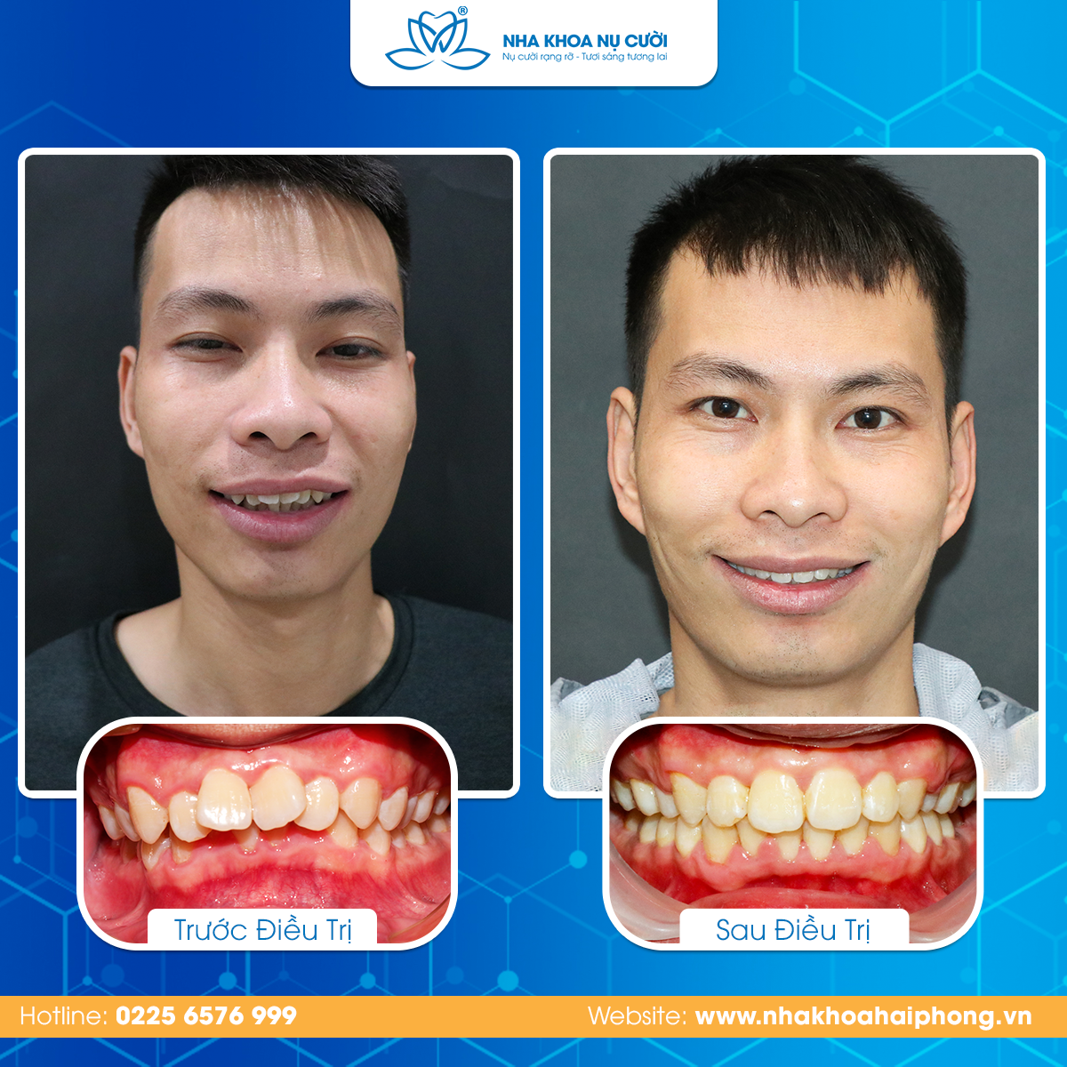 Vì sao răng bị ố vàng khi niềng?