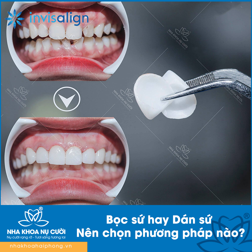 Bọc Răng Sứ hay Dán Sứ – Nên chọn phương pháp nào?