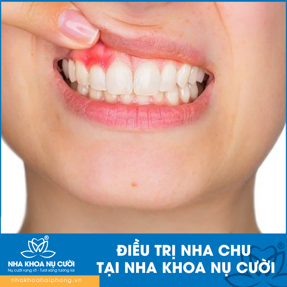 ĐIỀU TRỊ NHA CHU TẠI NHA KHOA NỤ CƯỜI