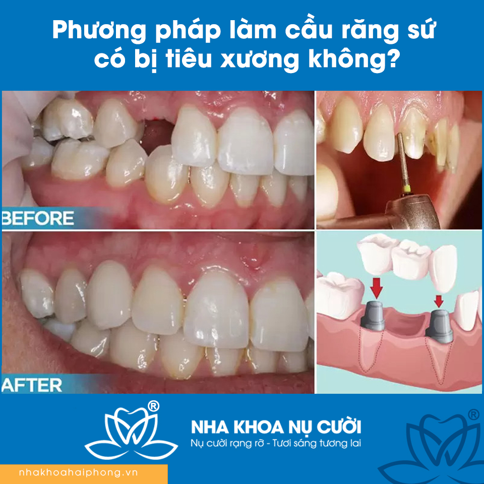 Phương pháp làm cầu răng sứ có bị tiêu xương không?