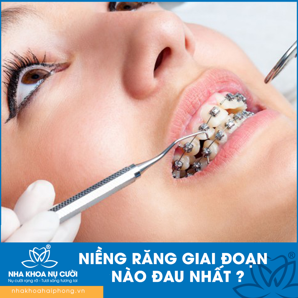 NIỀNG RĂNG GIAI ĐOẠN NÀO ĐAU NHẤT?