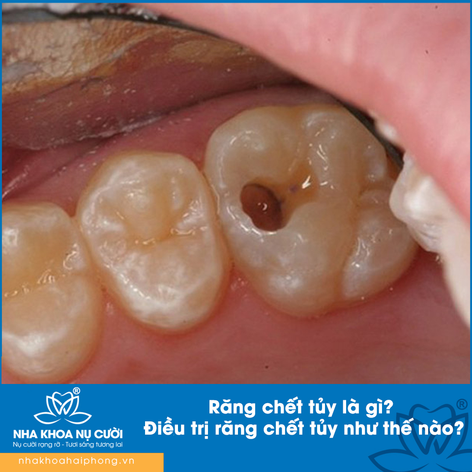 Răng chết tủy là gì? Điều trị răng chết tủy như thế nào?