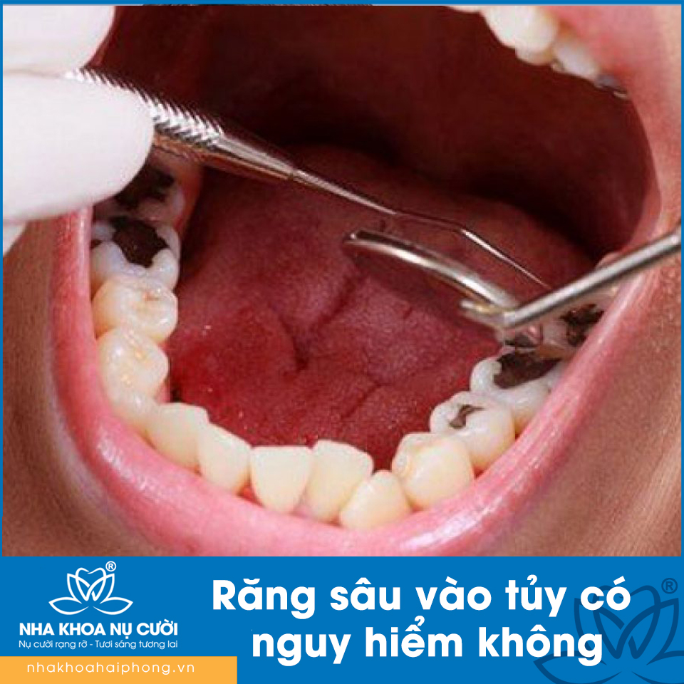 Răng sâu vào tủy có nguy hiểm không, điều trị thế nào?