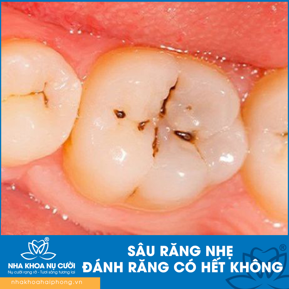 SÂU RĂNG NHẸ ĐÁNH RĂNG CÓ HẾT KHÔNG?