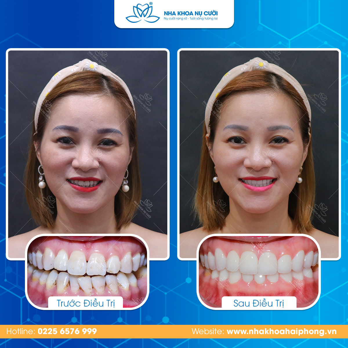 Nụ cười đẹp rạng ngời nhờ thẩm mỹ răng sứ