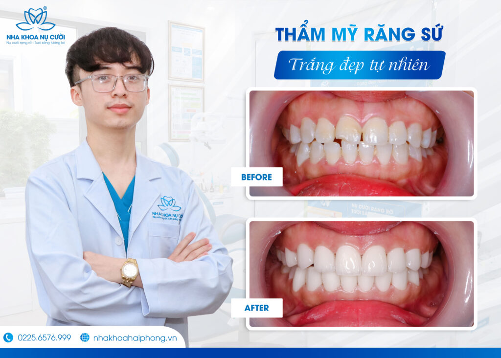 THẨM MỸ RĂNG SỨ, TRẮNG ĐẸP TỰ NHIÊN