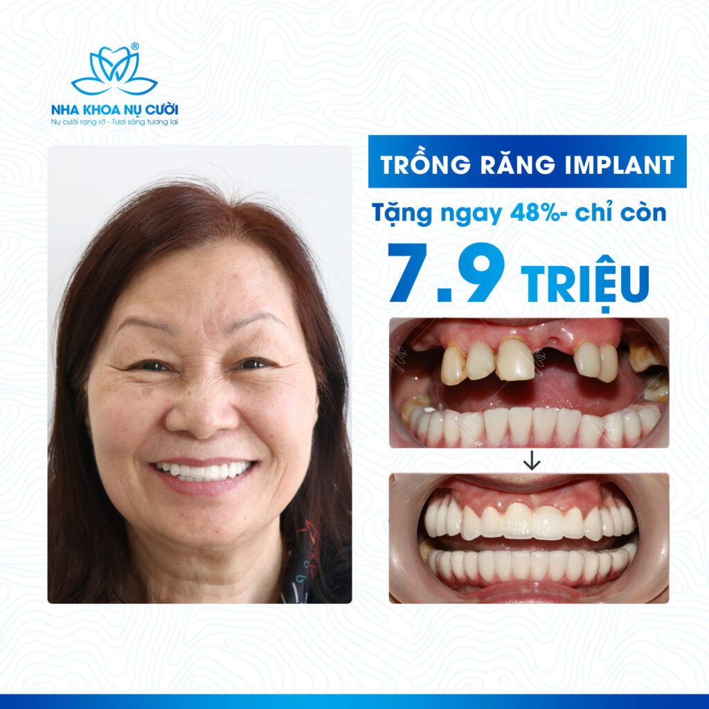 Ưu Đãi Hấp Dẫn Giảm 48% Trồng răng Implant