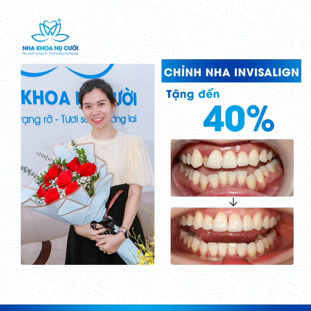 Ưu Đãi Hấp Dẫn Giảm 48% Niềng Răng Invisalign