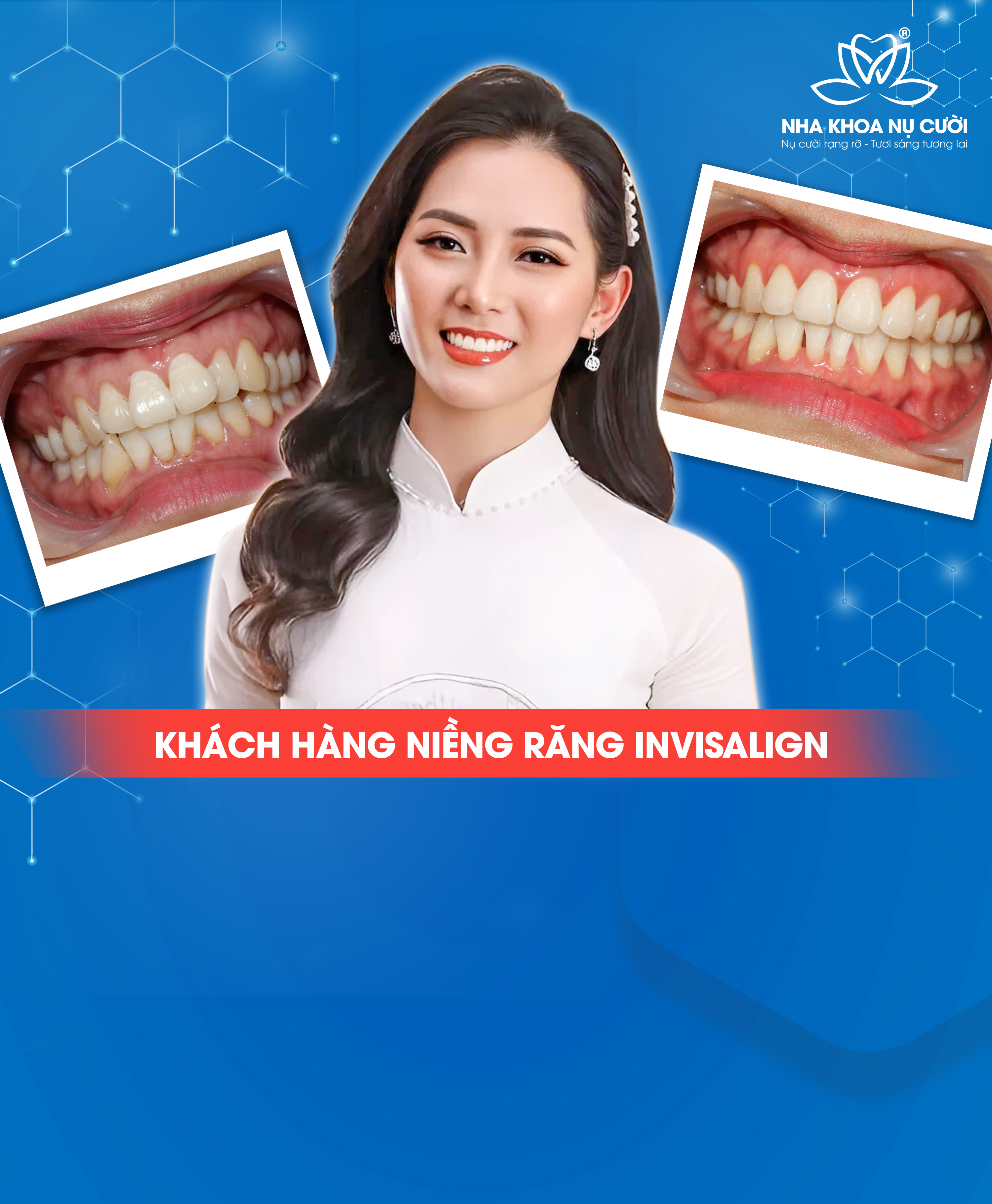 Niềng Răng & Invisalign Cá Nhân Hóa