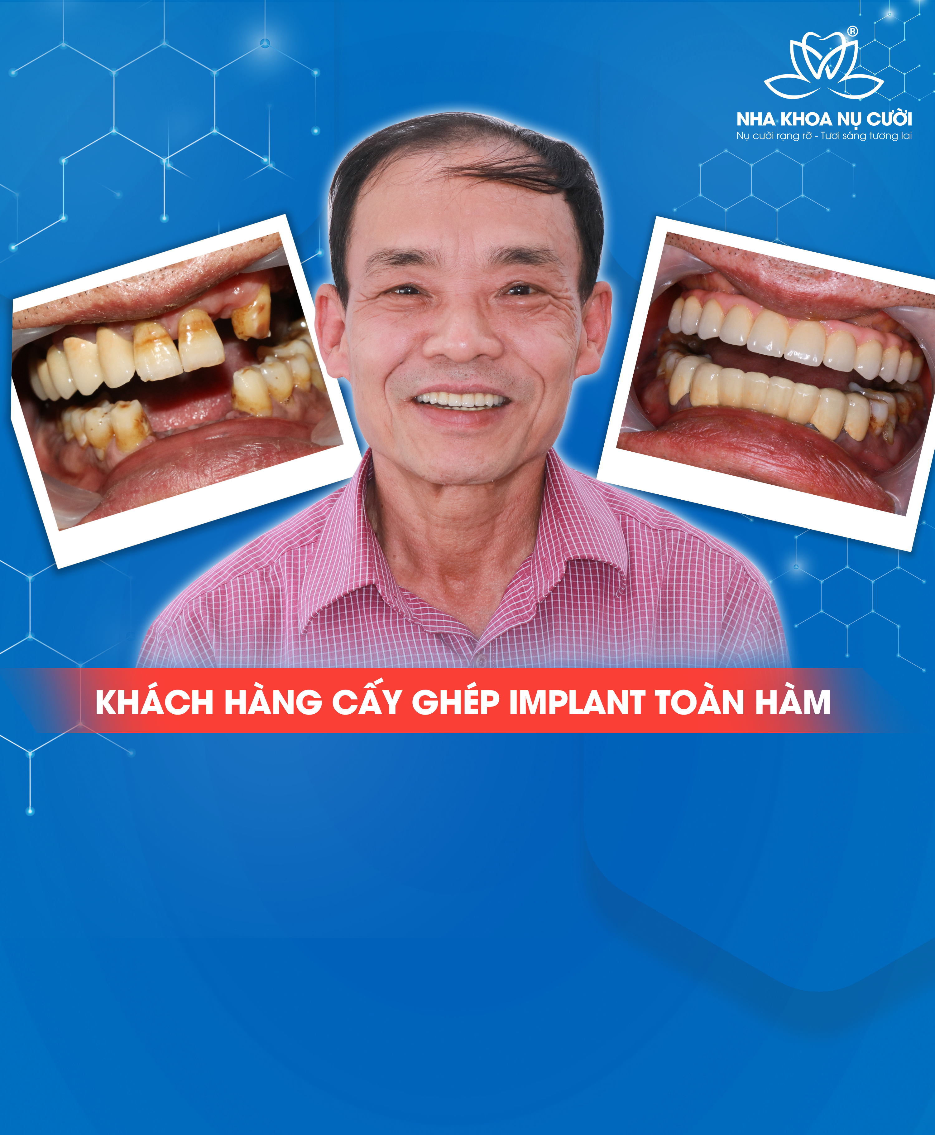 Trồng Răng Implant Chuyên Sâu