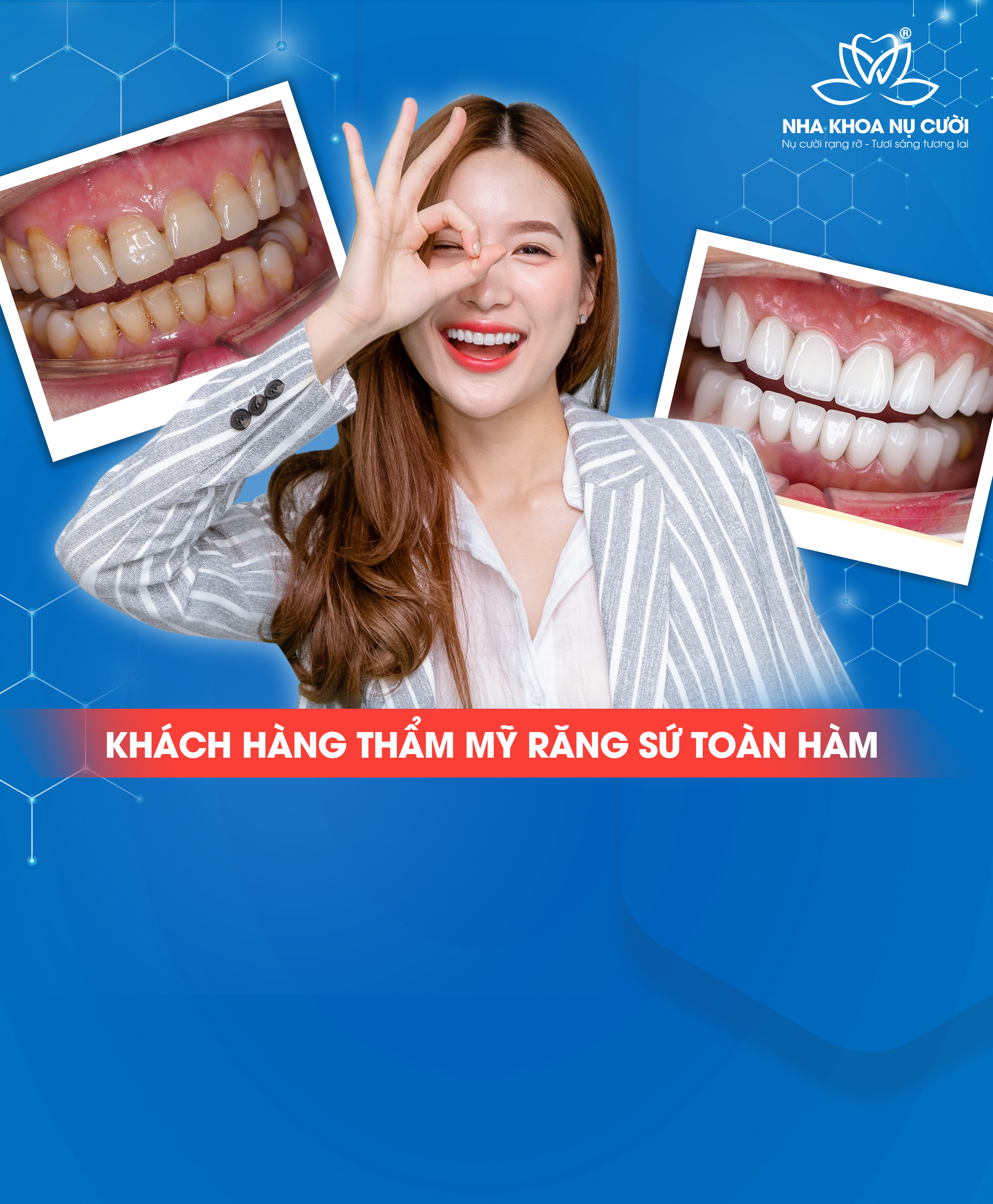 Điều Trị Thẩm Mỹ Răng Sứ Tự Nhiên
