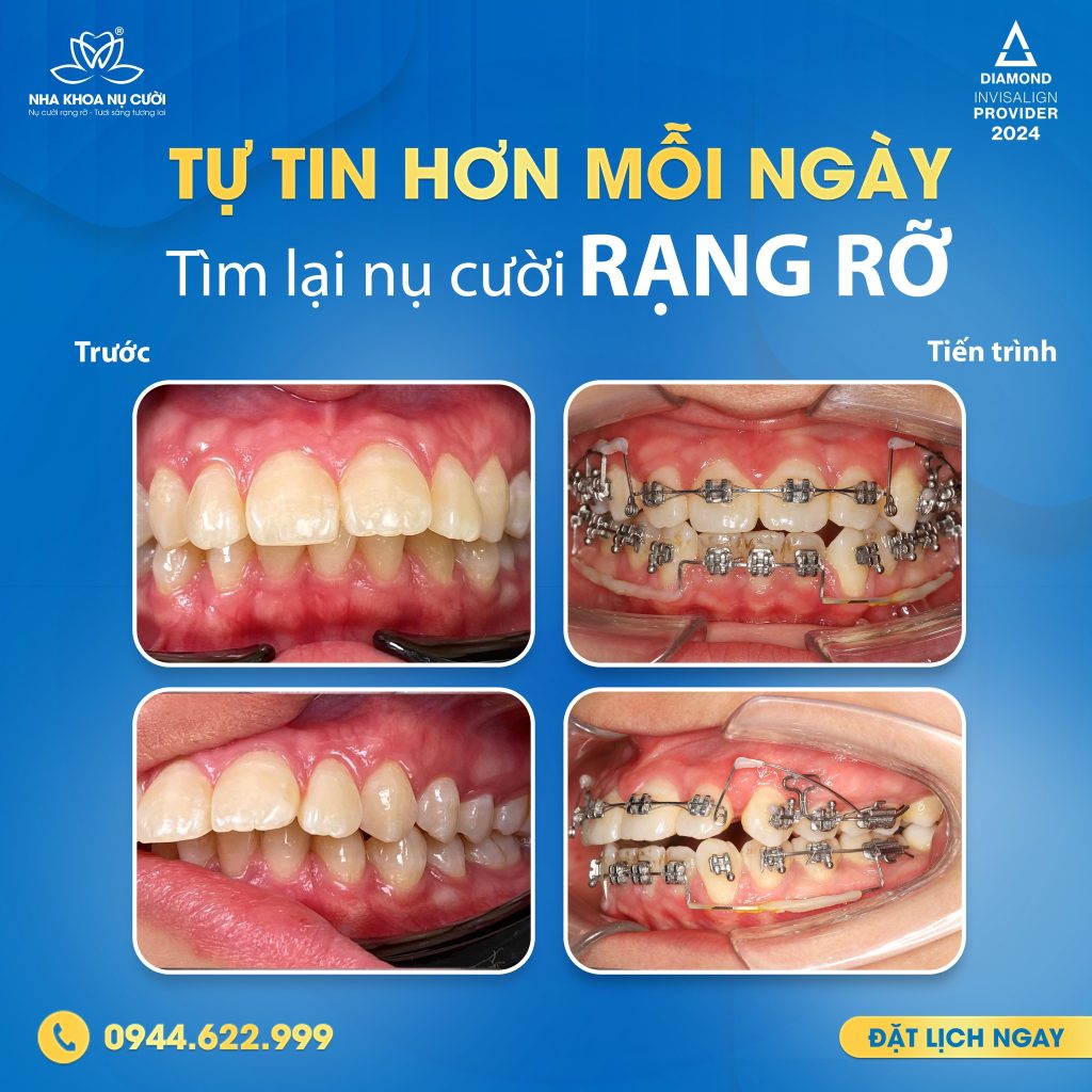 so-sanh-nieng-rang