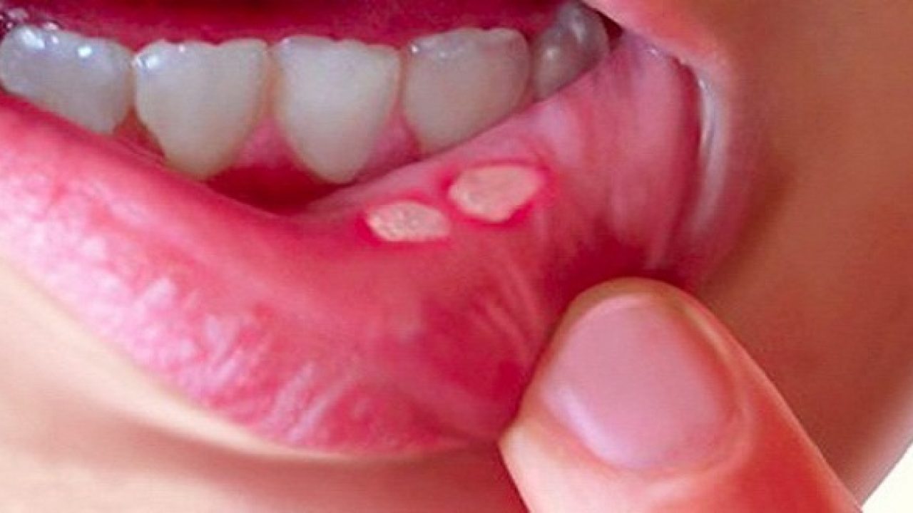 Nhiệt Miệng: Nguyên Nhân, Triệu Chứng và Cách Điều Trị Hiệu Quả