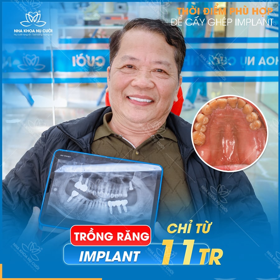 THỜI GIAN NÀO PHÙ HỢP ĐỂ CẤY GHÉP IMPLANT?