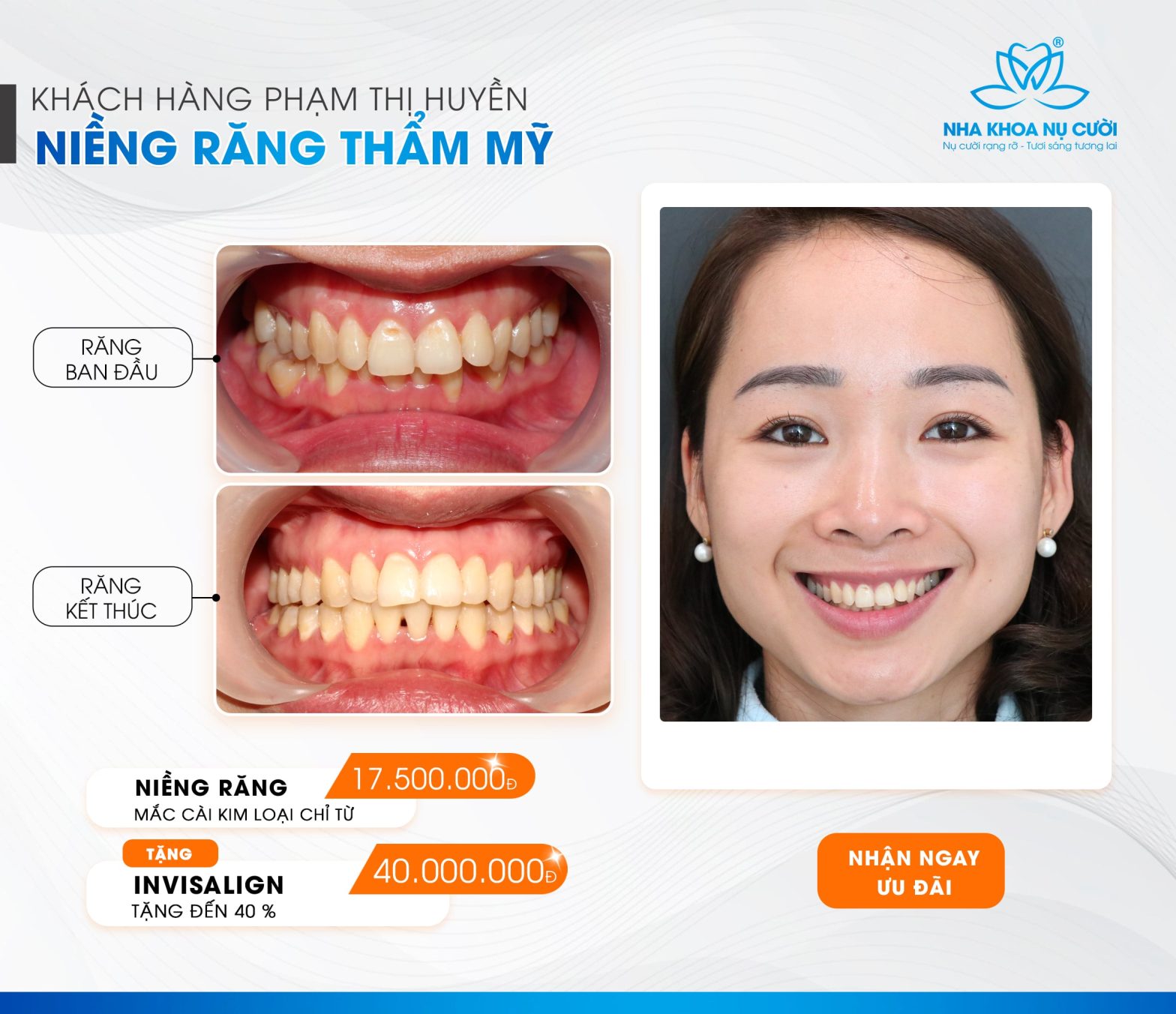 Hành Trình Niềng Răng Của Chị Phạm Thị Huyền