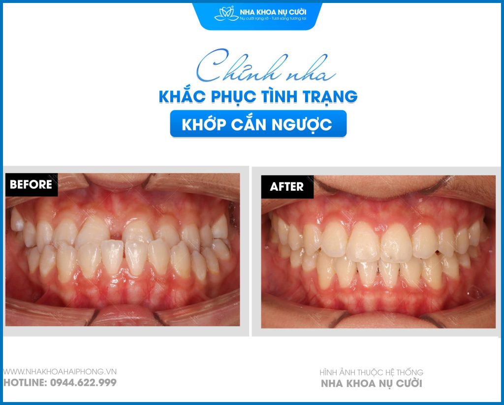 khop-can-nguoc