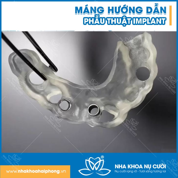 Implant