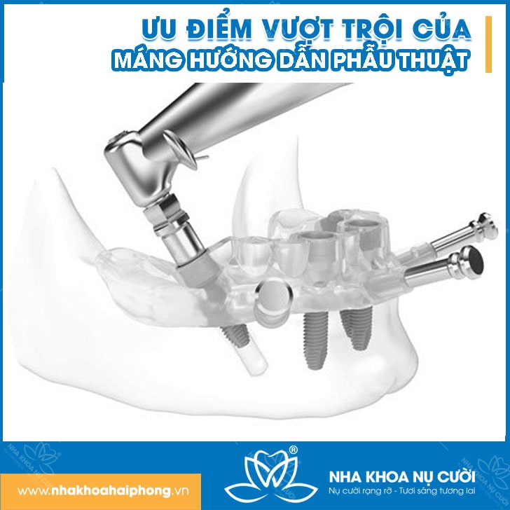 Implant