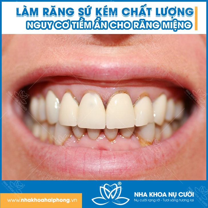 Hậu Quả Của Việc Làm Răng Sứ Kém Chất Lượng