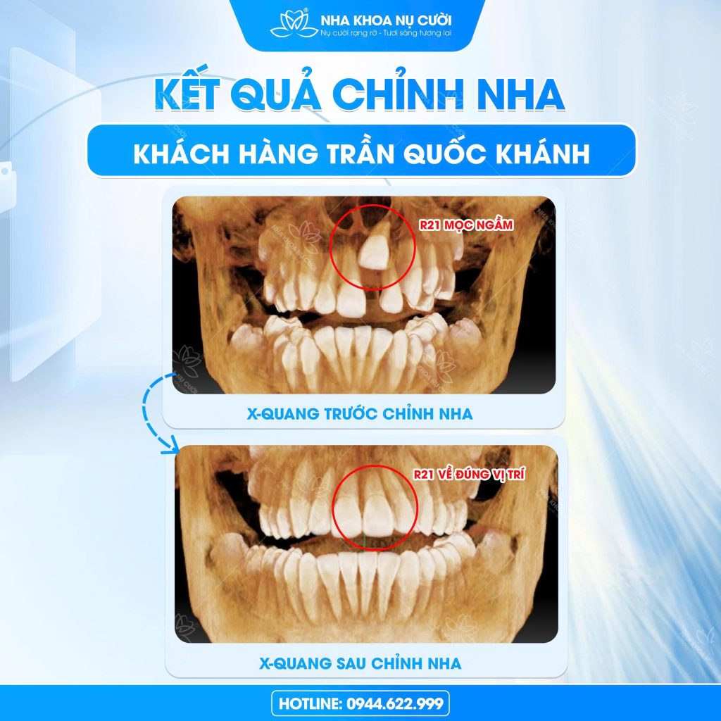 rang-cua-moc-ngam-ơ-tre