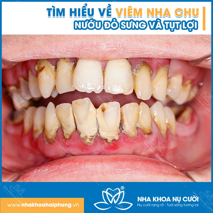 viem-nha-chu